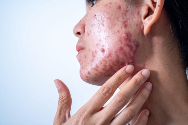Acne Unveiled: Understanding the Causes and Triggers Behind Breakouts